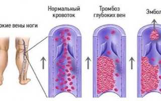 Тромбоз подколенной вены – причины, симптомы, лечение