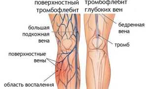 Тромбофлебит при беременности. Причины, симптомы, лечение