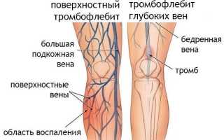 Тромбофлебит при беременности. Причины, симптомы, лечение