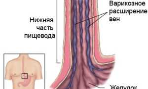 Варикозное расширение вен пищевода: причины, симптомы, лечение