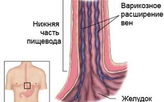 Варикозное расширение вен пищевода: причины, симптомы, лечение