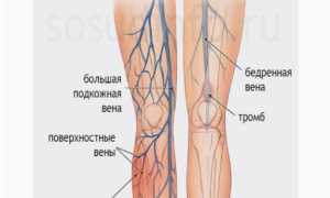 Способы лечения тромбофлебита и препараты