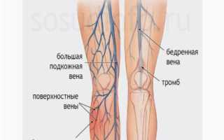 Способы лечения тромбофлебита и препараты