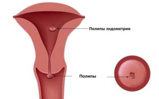 УЗИ-диагностика при полипе эндометрия: можно ли новообразование перепутать с беременностью