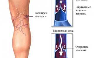 Глубокий варикоз нижних конечностей: признаки, симптомы, лечение
