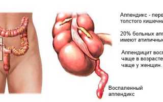 Осложнения после аппендицита: возможные проблемы и последствия
