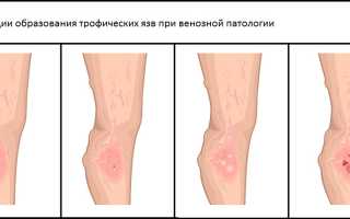 Трофическая язва – начальная стадия на ноге, фото