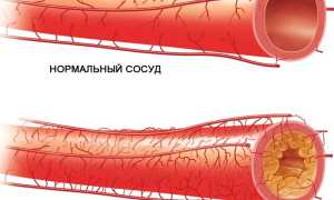 Облитерирующий атеросклероз сосудов нижних конечностей
