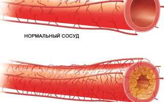 Облитерирующий атеросклероз сосудов нижних конечностей