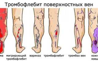 Лечение острого тромбофлебита поверхностных вен нижних конечностей