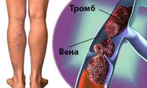 Флеботромбоз глубоких вен нижних конечностей