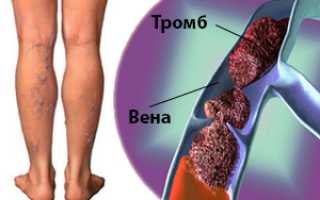Флеботромбоз глубоких вен нижних конечностей