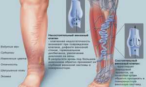 Венозная недостаточность нижних конечностей – симптомы и лечение