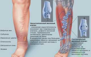 Венозная недостаточность нижних конечностей – симптомы и лечение