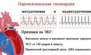 Лечение аритмии и тахикардии народными средствами