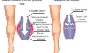 Чем опасен варикоз вен на ногах у женщин и мужчин