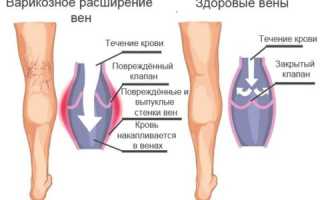 Чем опасен варикоз вен на ногах у женщин и мужчин