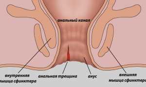 Боль в заднем проходе во время беременности – методы лечения