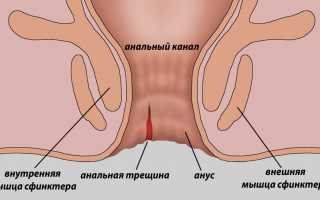Боль в заднем проходе во время беременности – методы лечения