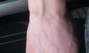 Почему появляются вены на руках у женщин и что с этим делать?