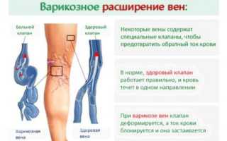 Стадии варикоза, первые признаки варикоза на ногах