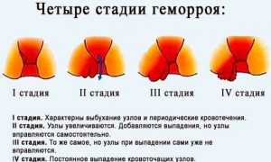 Как проявляется геморрой на разных стадиях?