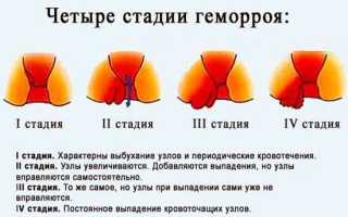 Как проявляется геморрой на разных стадиях?