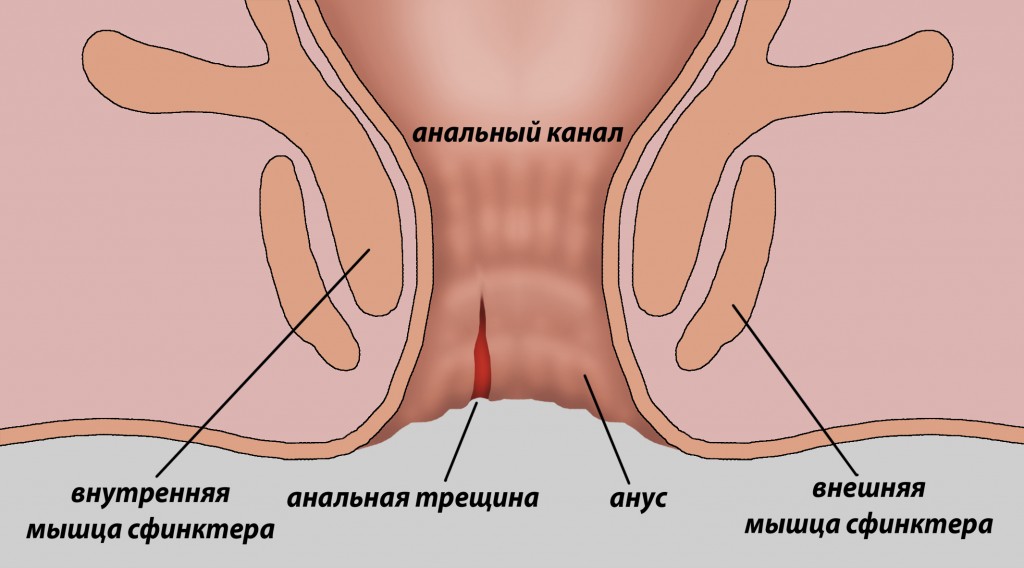 Боль в заднем проходе