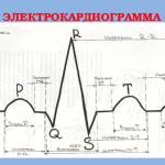 Электрокардиограмма бб