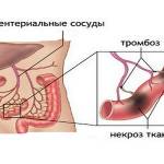 Мезентериальный тромбоз кишечника