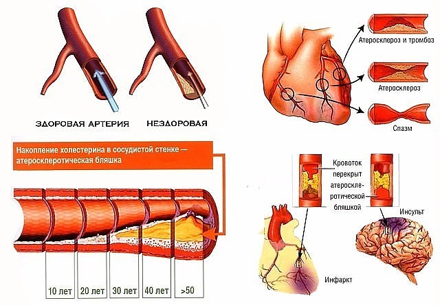 Проблема атеросклероза