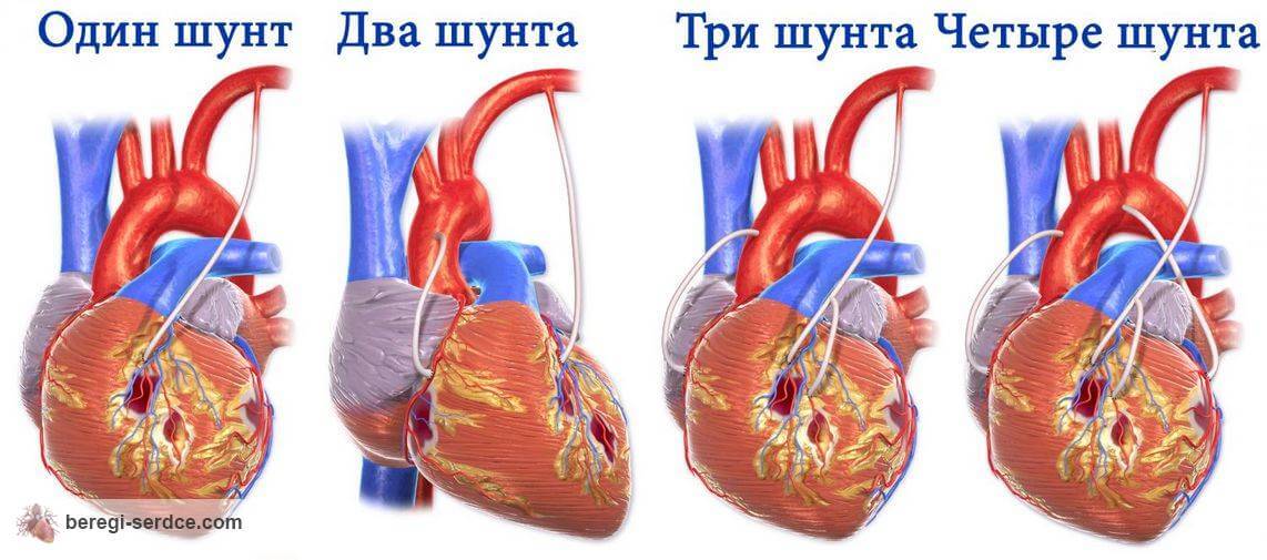 Разновидности АКШ..
