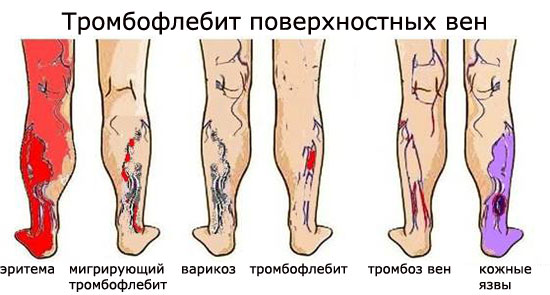 Тромбофлебит –