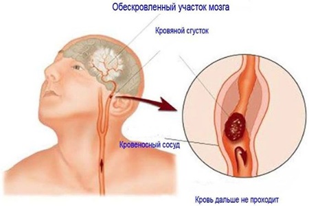 Тромбоз кавернозного синуса