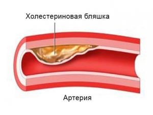 бляшка в артерии
