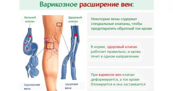 что такое варикоз