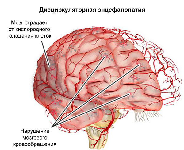 дисциркуляторная энцефалопатия, 