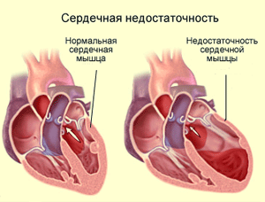 форма сердечно-сосудистой недостаточности