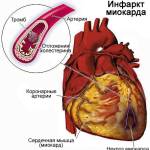 инфаркт миокарда....