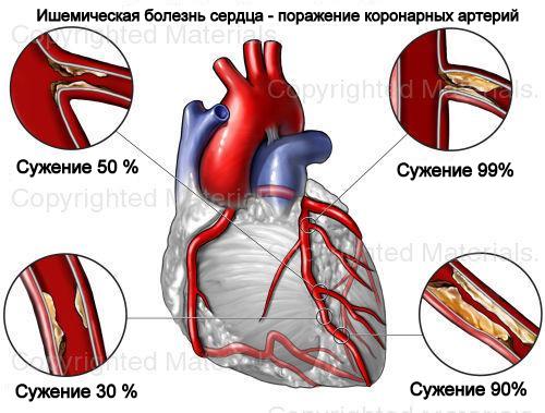 ишемическую болезнь сердца