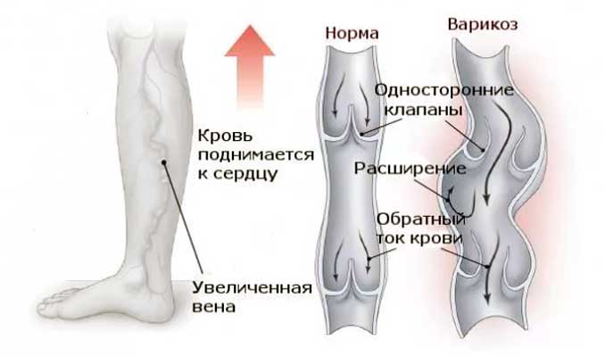 измененные варикозом сосуды
