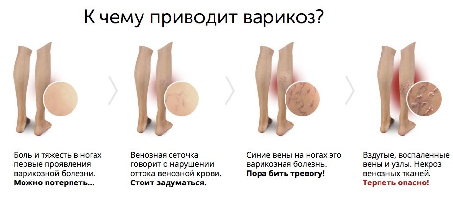 к чему приводит варикоз
