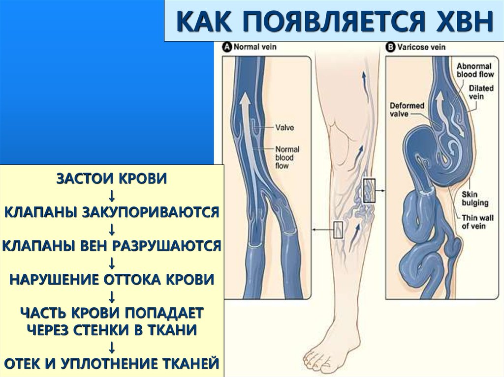 как появляется хвн