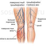 лечение острого тромбофлебита