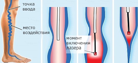 лечение варикоза лазером