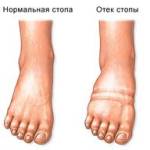 лимфедема нижних