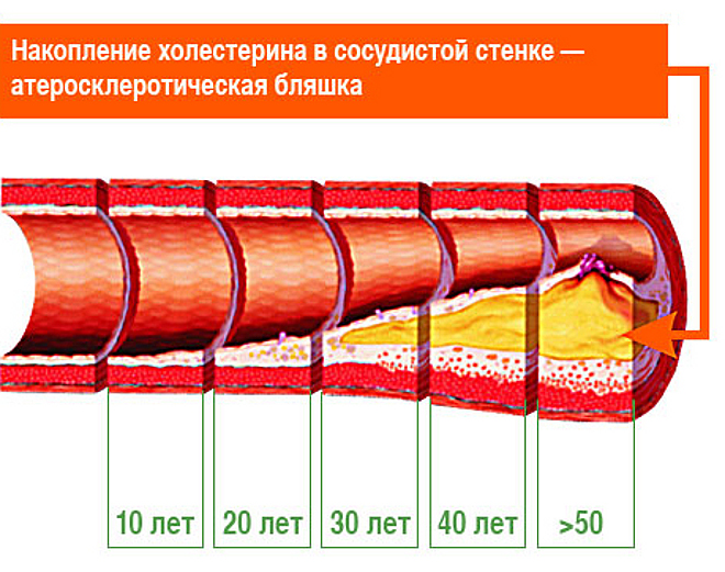 обтурации просвета коронарного сосуда