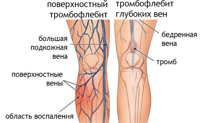 особенности тромбофлебита