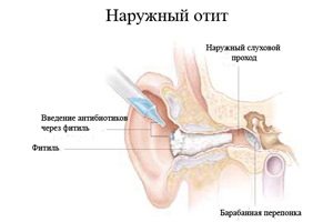 отит