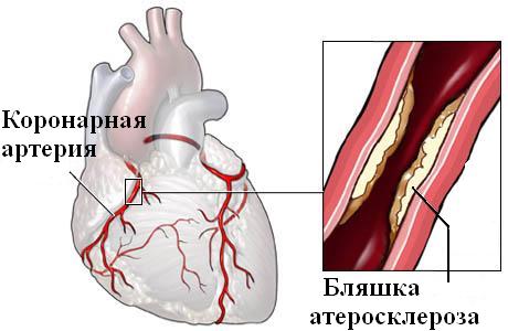 просвете коронарных сосудов
